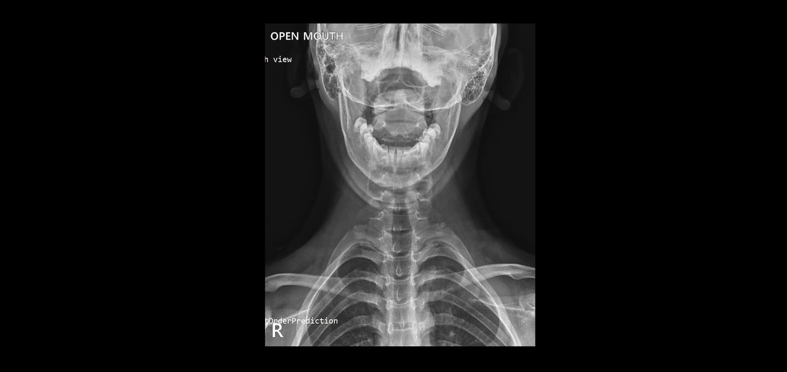 X-ray APOM