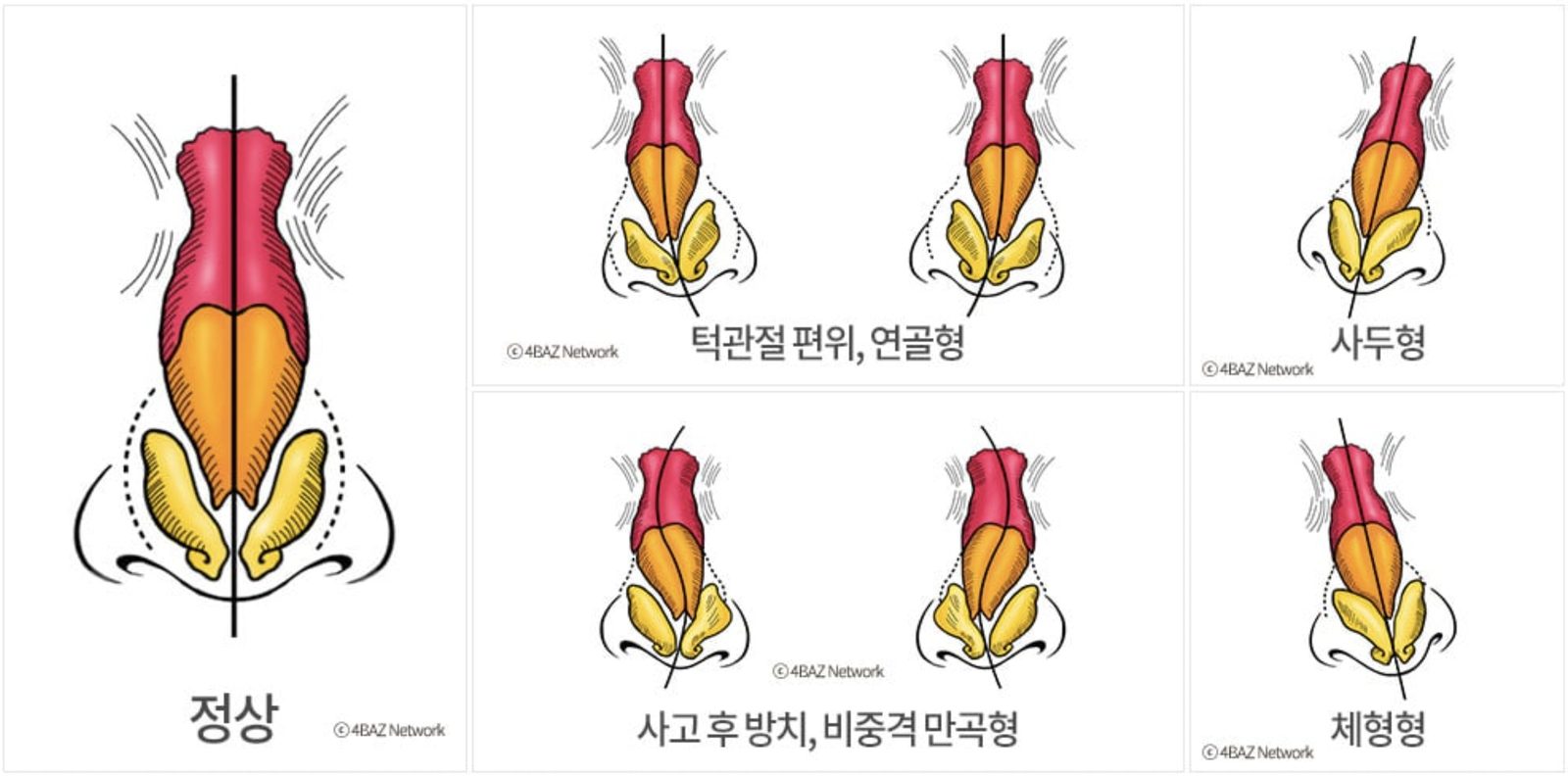 휜 코 검사