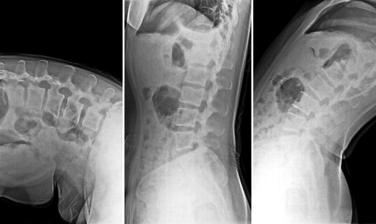 X-ray