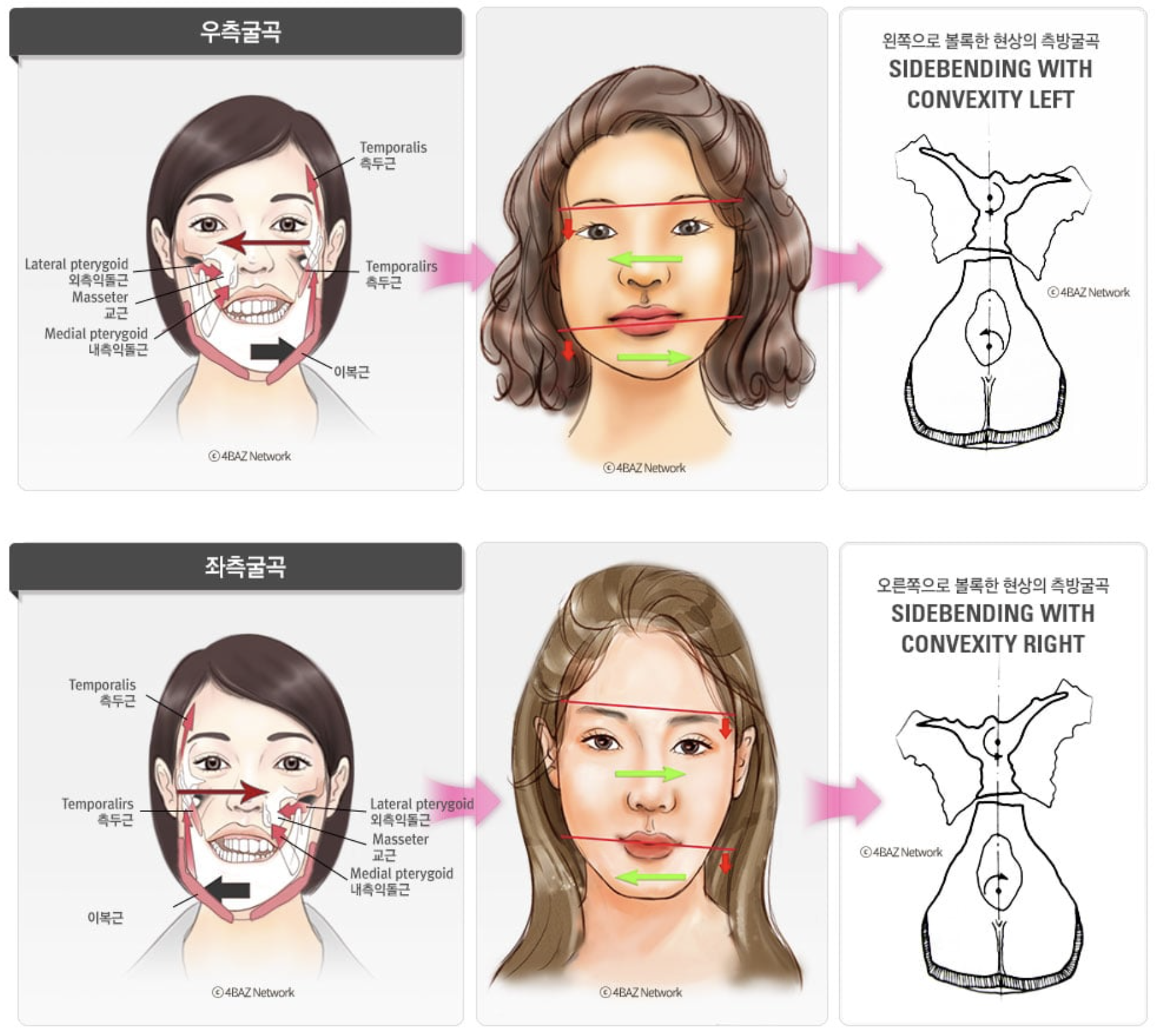 상·하악 반대 방향 유형
