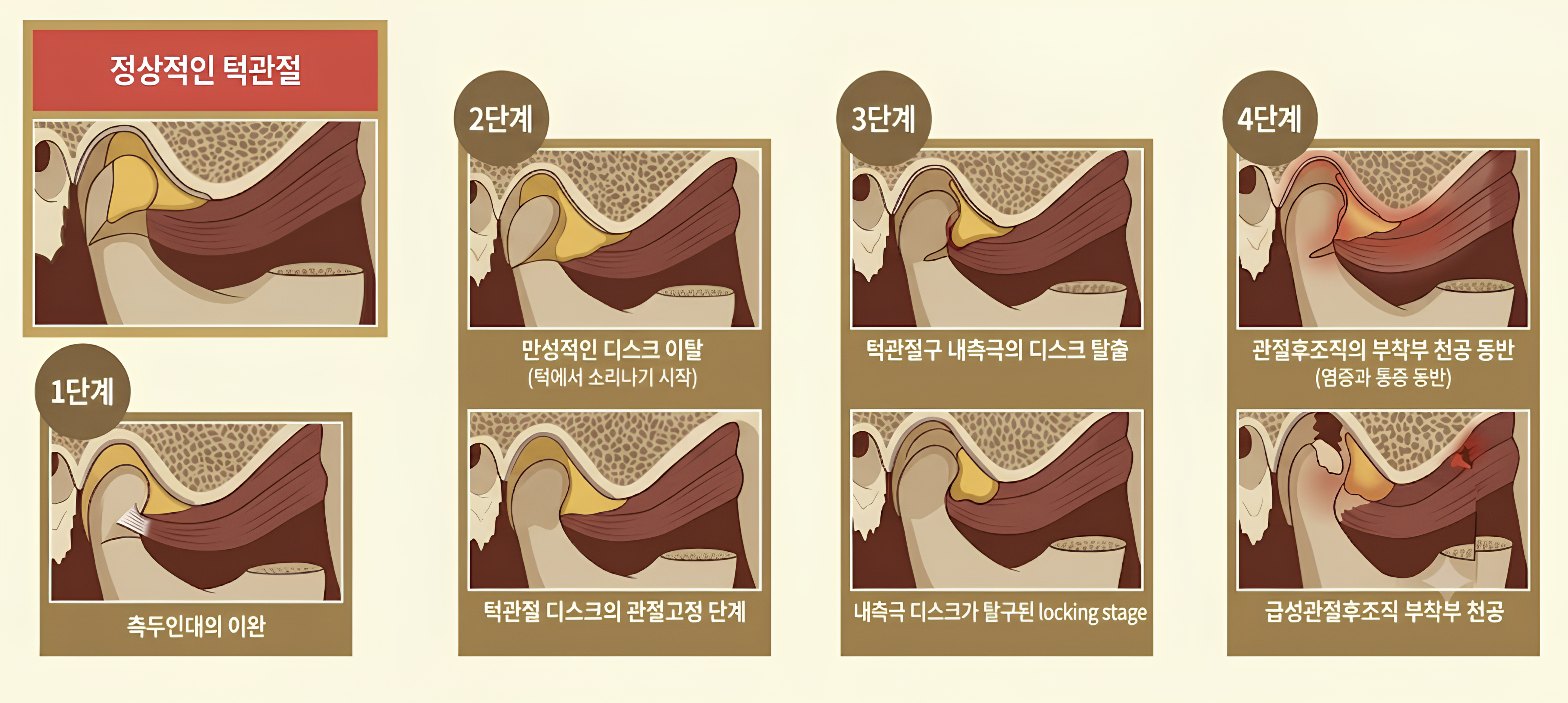 턱관절 디스크 4단계 진행 (정상 → 인대이완 → 디스크 이탈 → 잠김 → 천공)