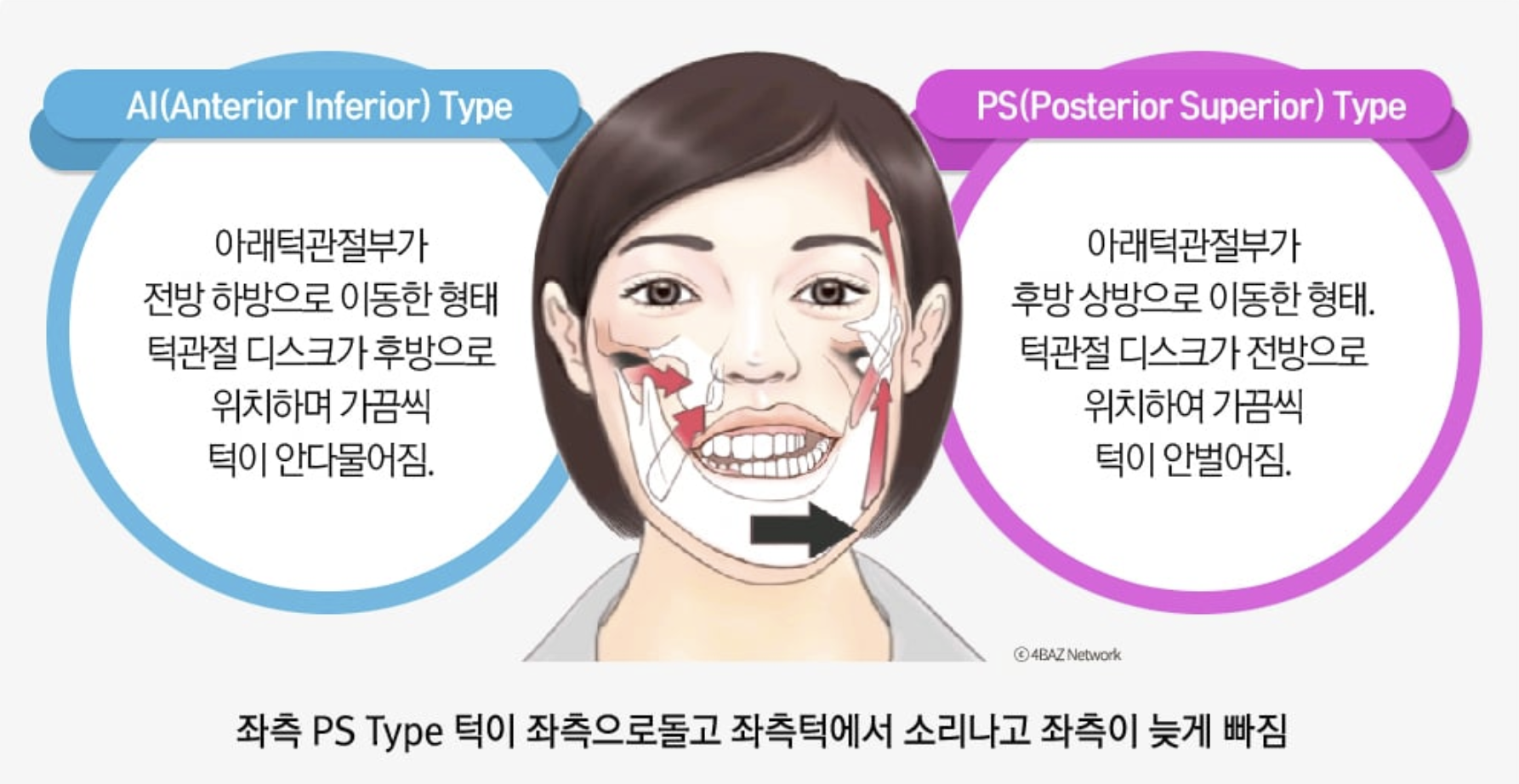 좌측 케이스 — AI·PS 유형