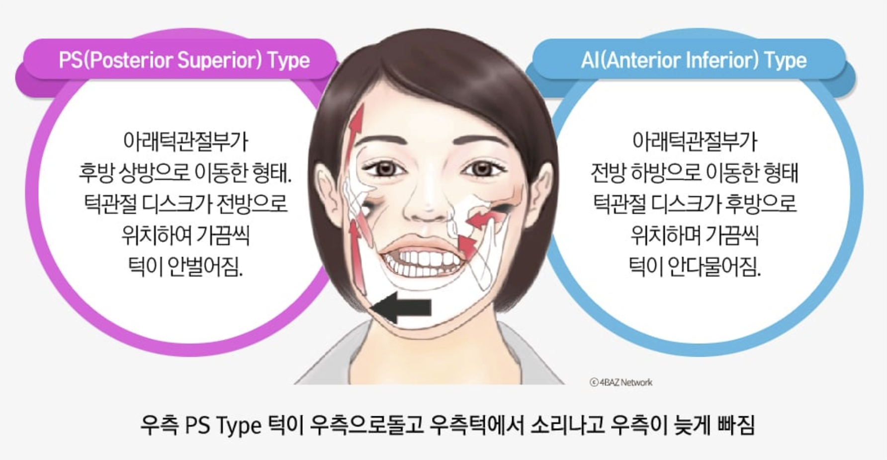우측 케이스 — AI·PS 유형
