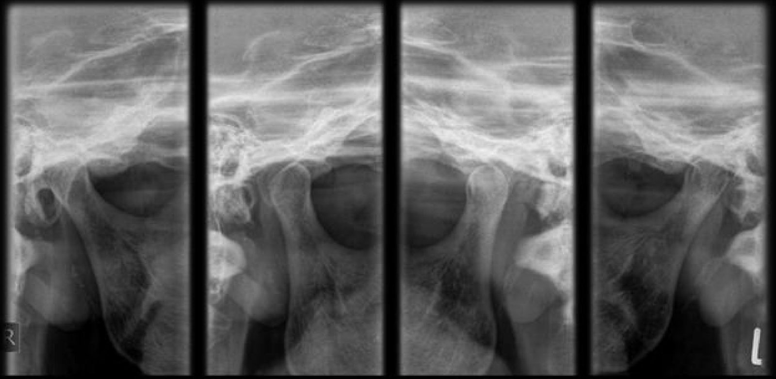 턱관절 X-ray